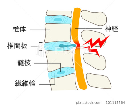 Illustration of a lumbar spine with a herniated disc Illustration of a lumbar spine with a herniated disc 101113364