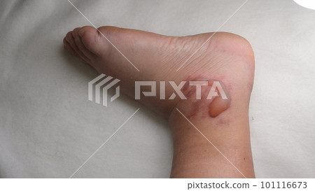 Swollen leg with blisters filled with fluid after frostbite close-up. Swollen foot with fluid-filled blisters from frostbite. Skin swollen in lumps. Foot with bloated. Disease sickness corn callus Swollen leg with blisters filled with fluid after frostbite close-up. Swollen foot with fluid-filled blisters from frostbite. Skin swollen in lumps. Foot with bloated. Disease sickness corn callus 101116673