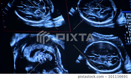 Utrasound image on the monitor close-up. Ultrasound Scan display. Screening Ultrasonography Analysis of person. Ultrasound examination Using Scanner. Ultrasound Scan Device. Echocardiography 101116691
