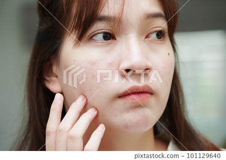 Acne pimple and scar on skin face, disorders of sebaceous glands, teenage girl skincare beauty problem. 101129640
