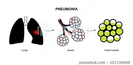 Pneumonia infection poster Pneumonia infection poster 101136009
