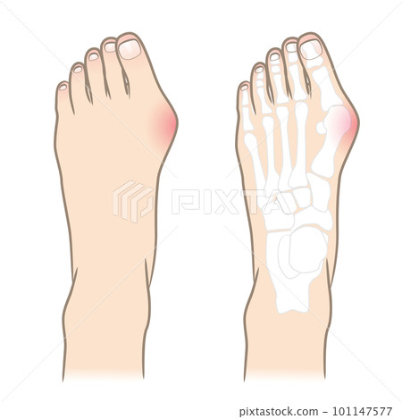 拇趾外翻腳圖 101147577