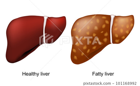 fatty liver disease. Healthy liver and hepatic steatosis. fatty liver disease. Healthy liver and hepatic steatosis. 101168992