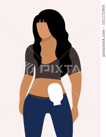 Colostomy bag. Young woman wearing colostomy bag. Vector isolated illustration. 101172905