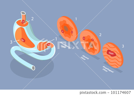 3D Isometric Flat Vector Conceptual Illustration of Peptic Ulcer Stomach Disease 101174607