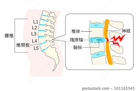 Explanatory illustration enlarged view of the lumbar spine with a strained back 101183545