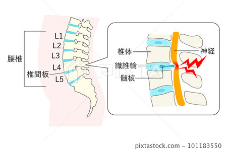 腰椎椎間盤突出症的說明圖放大圖 腰椎椎間盤突出症的說明圖放大圖 101183550