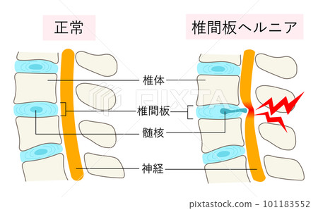 Comparison illustration of normal lumbar vertebrae and intervertebral disc herniation 101183552