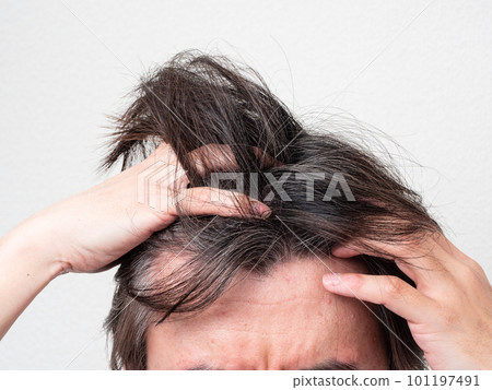 頭髮花白頭髮稀疏男頭 頭髮花白頭髮稀疏男頭 101197491