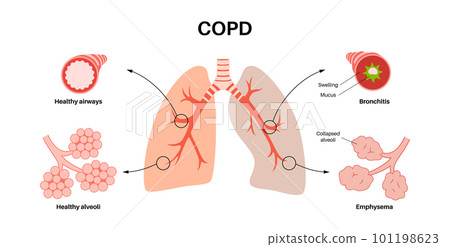 Chronic obstructive pulmonary disease Chronic obstructive pulmonary disease 101198623