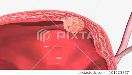 The Bladder Cancer, Stage II 101225877