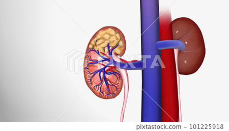 The Kidney Cancer, Stage II The Kidney Cancer, Stage II 101225918