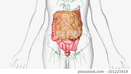 Stage III ovarian cancer has spread beyond the pelvis area to the abdomen. Stage III ovarian cancer has spread beyond the pelvis area to the abdomen. 101225919