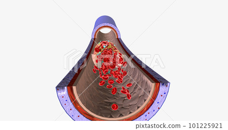 A blood clot in a vein, or venous thrombus, is the clumping of blood in vessels that bring blood back to the heart. 101225921