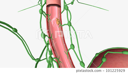 In stage I esophageal cancer, the tumor has spread through some of the layers of the esophageal wall. In stage I esophageal cancer, the tumor has spread through some of the layers of the esophageal wall. 101225929