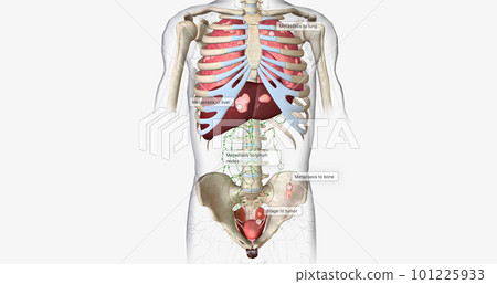 The Bladder Cancer, Stage IV The Bladder Cancer, Stage IV 101225933
