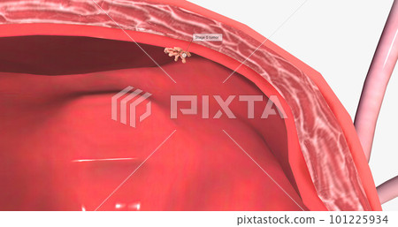 Bladder cancer is a type of cancer that originates in the urothelial cells of the bladder. 101225934