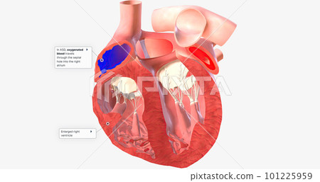 Atrial Septal Defect, Blood Flow Atrial Septal Defect, Blood Flow 101225959