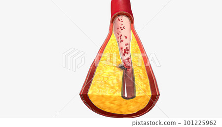 Atherothrombosis is a cardiovascular disease characterized by ruptured atherosclerotic plaque and clot formation. Atherothrombosis is a cardiovascular disease characterized by ruptured atherosclerotic plaque and clot formation. 101225962