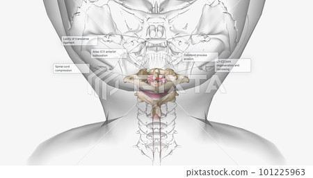 The Rheumatoid Arthritis in Cervical Spine The Rheumatoid Arthritis in Cervical Spine 101225963