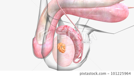 Stage I testicular cancer is characterized by a tumor that has not spread to the lymph nodes or other organs. Stage I testicular cancer is characterized by a tumor that has not spread to the lymph nodes or other organs. 101225964