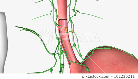 In stage II esophageal cancer, the tumor has spread to certain areas of the esophageal wall. 101226211