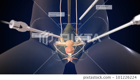 A hysterectomy is a surgical procedure to remove the uterus. A hysterectomy is a surgical procedure to remove the uterus. 101226224