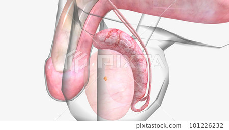 Testicular tumors are the most common type of solid cancerous tumors in men between the ages of 15 and 35. Testicular tumors are the most common type of solid cancerous tumors in men between the ages of 15 and 35. 101226232