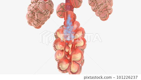 COVID-19, Acute Respiratory Distress Syndrome COVID-19, Acute Respiratory Distress Syndrome 101226237