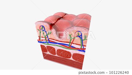 Anal fissure is a small tear in the lining of the anal mucosa. Anal fissure is a small tear in the lining of the anal mucosa. 101226240