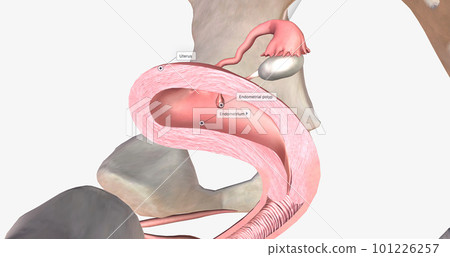 Endometrial polyps are abnormal growths of the inner lining of the uterus, known as the endometrium. 101226257