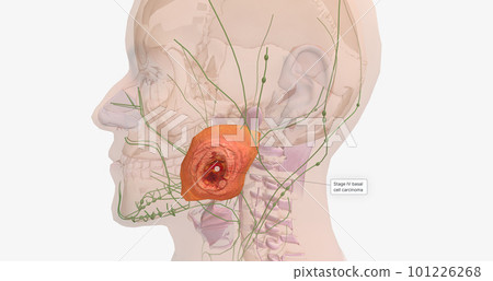 Basal Cell Carcinoma in Tissue, Stage IV Basal Cell Carcinoma in Tissue, Stage IV 101226268