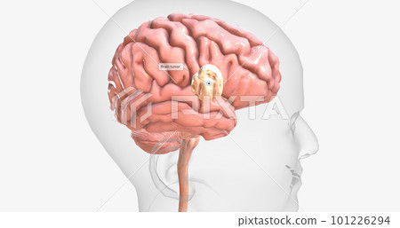 Brain tumors are abnormal growths found in brain tissue. Brain tumors may be benign or malignant. Brain tumors are abnormal growths found in brain tissue. Brain tumors may be benign or malignant. 101226294