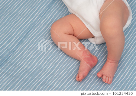 Hemangioma red birthmark on leg of newborn baby 101234430