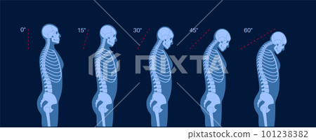 Neck vertebrae deformity Neck vertebrae deformity 101238382