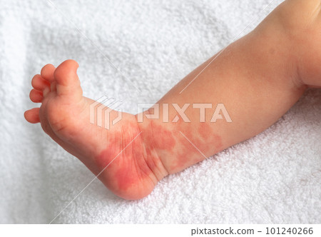 Hemangioma red birthmark on the leg of newborn baby 101240266