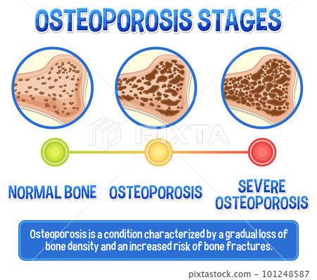 Informative poster of Osteoporosis human bone 101248587