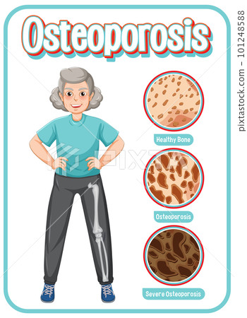 Comparison of normal bone and bone with Osteoporosis in old people 101248588