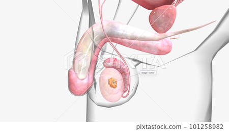 Stage I testicular cancer is characterized by a tumor that has not spread to the lymph nodes or other organs. 101258982