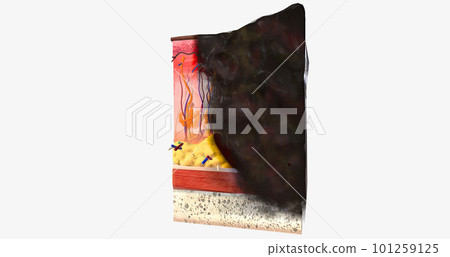 The In Stage III ALM Acral Lentiginous Melanoma The In Stage III ALM Acral Lentiginous Melanoma 101259125