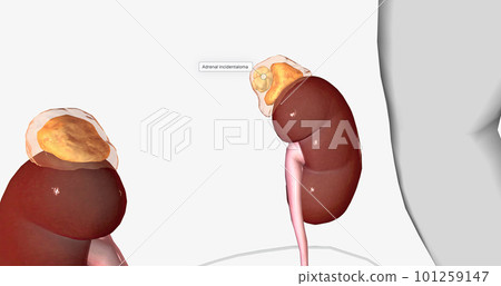 An adrenal incidentaloma is a solid mass in one or both adrenal glands. 101259147