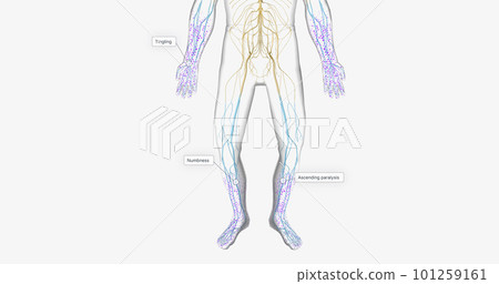 Guillain Barre syndrome is a rare disorder in which your body's immune system attacks your nerves. 101259161