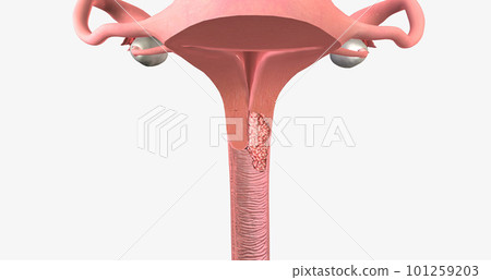 In stage II, the cancer has invaded the upper part of the vagina and tissue near the uterus called the parametrium. In stage II, the cancer has invaded the upper part of the vagina and tissue near the uterus called the parametrium. 101259203