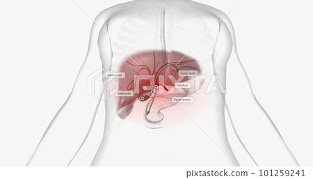 Gallstones are pieces of solid material that form in the gallbladder, a small hollow organ located beneath the liver. Gallstones are pieces of solid material that form in the gallbladder, a small hollow organ located beneath the liver. 101259241