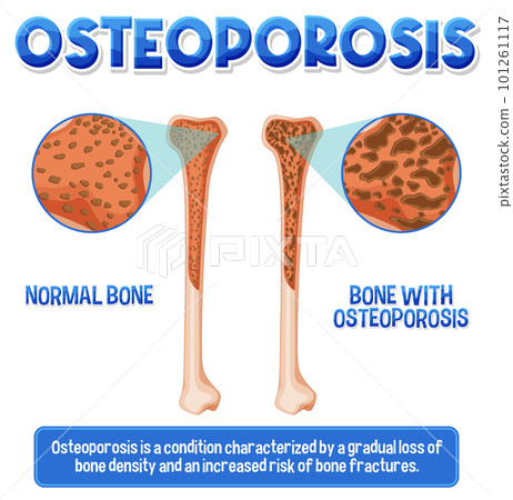 Informative poster of Osteoporosis human bone 101261117