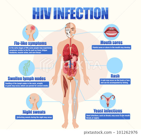 Informative poster of of HIV infection 101262976