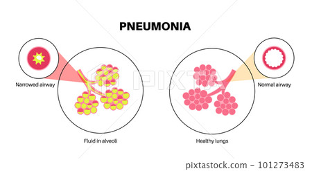Pneumonia infection poster 101273483