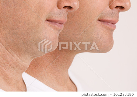 A close portrait of an aged man before and after the facial rejuvenation procedure. Correction of the chin shape liposuction of the neck. Fillers in the cheekbones and chin. The result of the A close portrait of an aged man before and after the facial rejuvenation procedure. Correction of the chin shape liposuction of the neck. Fillers in the cheekbones and chin. The result of the 101283190