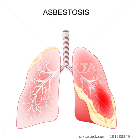 Asbestosis. Close-up of a cross section of human lungs with fibrosis and scarring Asbestosis. Close-up of a cross section of human lungs with fibrosis and scarring 101288249