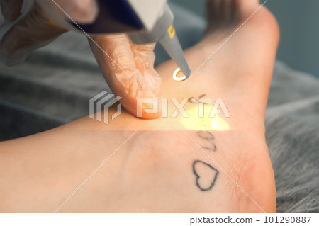 Laser removing of tattoo with words loser, lover and heart on woman's foot. 101290887